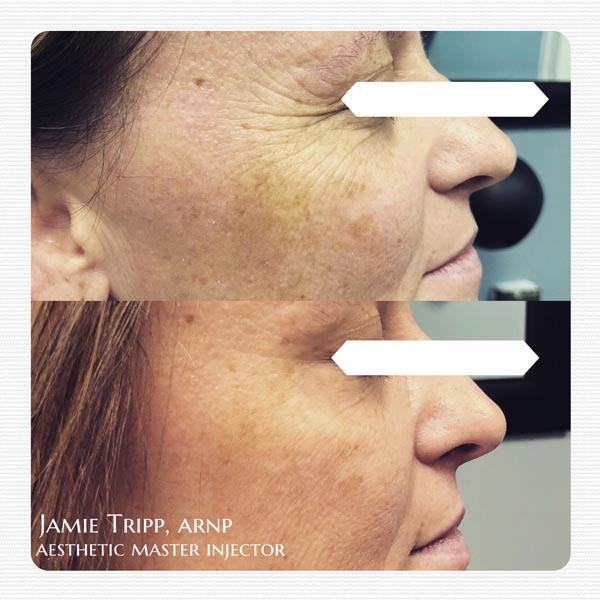 12 units per eye of Botox, 2 weeks after treatment