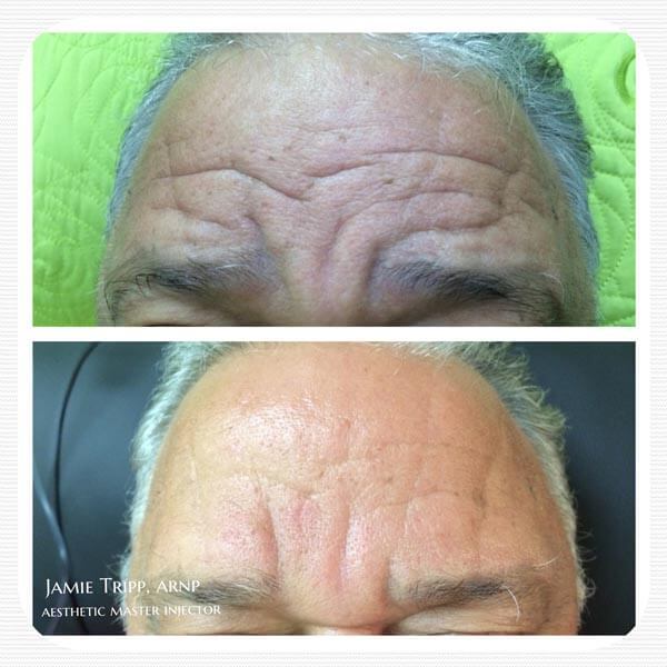 20 units of botox to forehead, 2 weeks after treatment