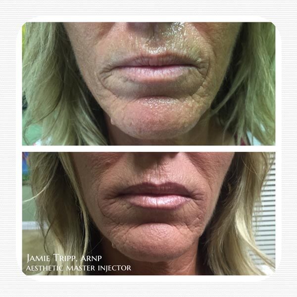 1 syringe Juvederm Volbella to lips and fine lines, 2 weeks after treatment