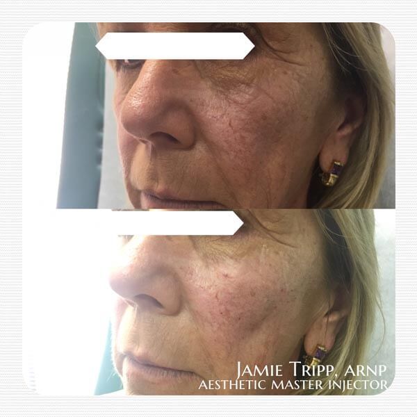 2 syringes Juvederm Voluma to cheeks, immediately after treatment