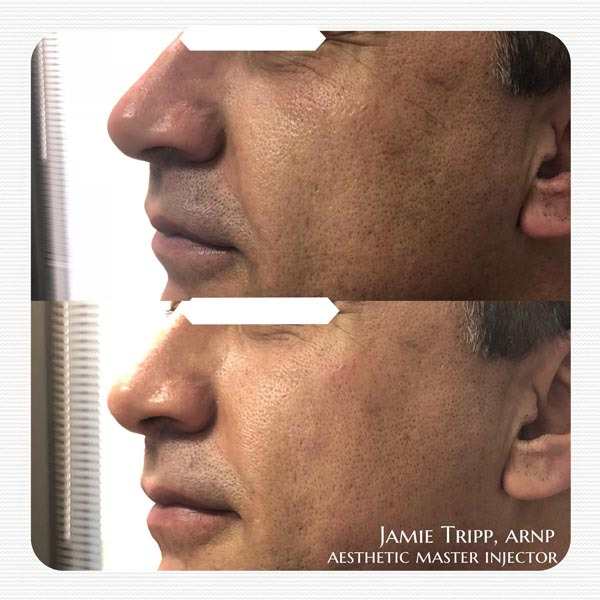1 syringe Juvederm Voluma to cheeks, immediately after treatment