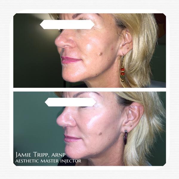 1 syringe Juvederm Voluma to cheeks, 2 weeks after treatment