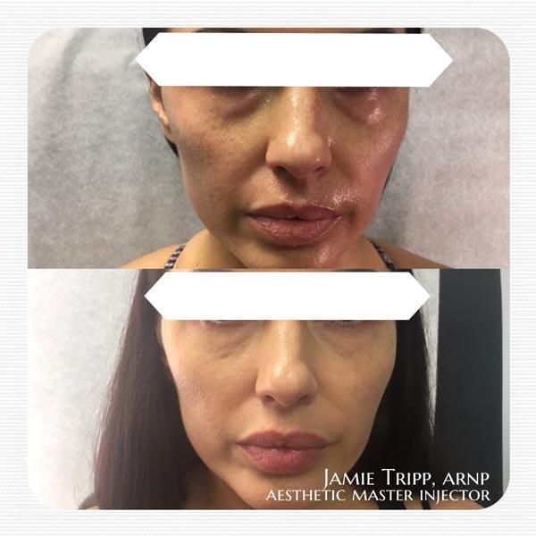 1/2 syringe Juvederm Volbella to under eyes, 2 weeks after treatment