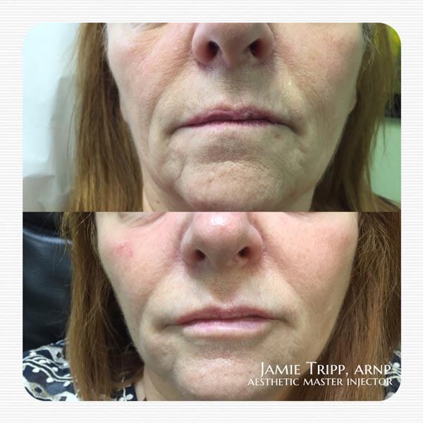 1 syringe Juvederm ultra to lips and 1 syringe Juvederm Ultra plus to smile lines and corners of mouth, 2 weeks after treatment