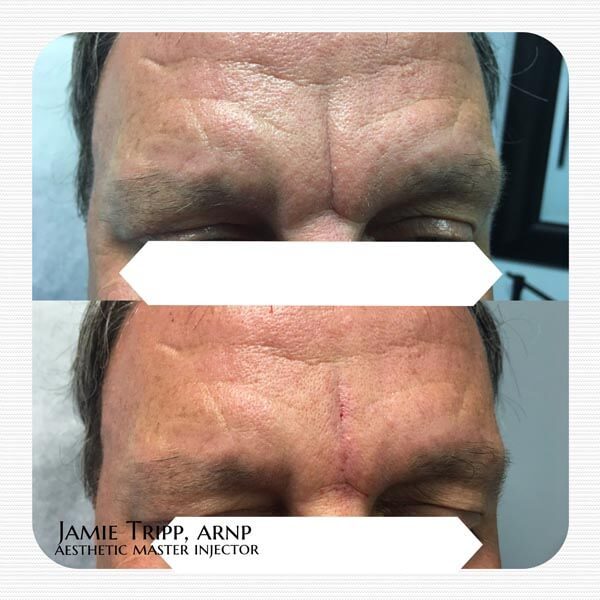 1/2 syringe Juvederm Vollure between brows, immediately after treatment