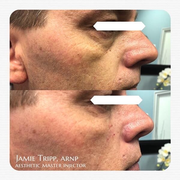 1 syringe Juvederm Voluma to cheeks and 1/2 syringe Juvederm Volbella to under eyes, immediately after treatment