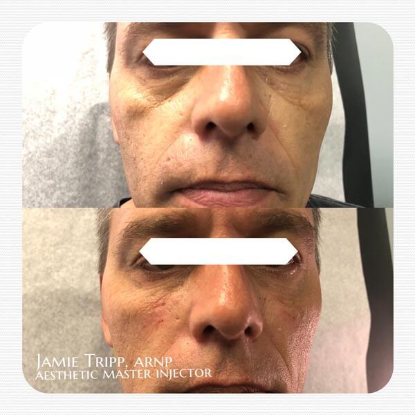 1 syringe Juvederm Voluma to cheeks and 1/2 syringe Juvederm Volbella to under eyes, immediately after treatment