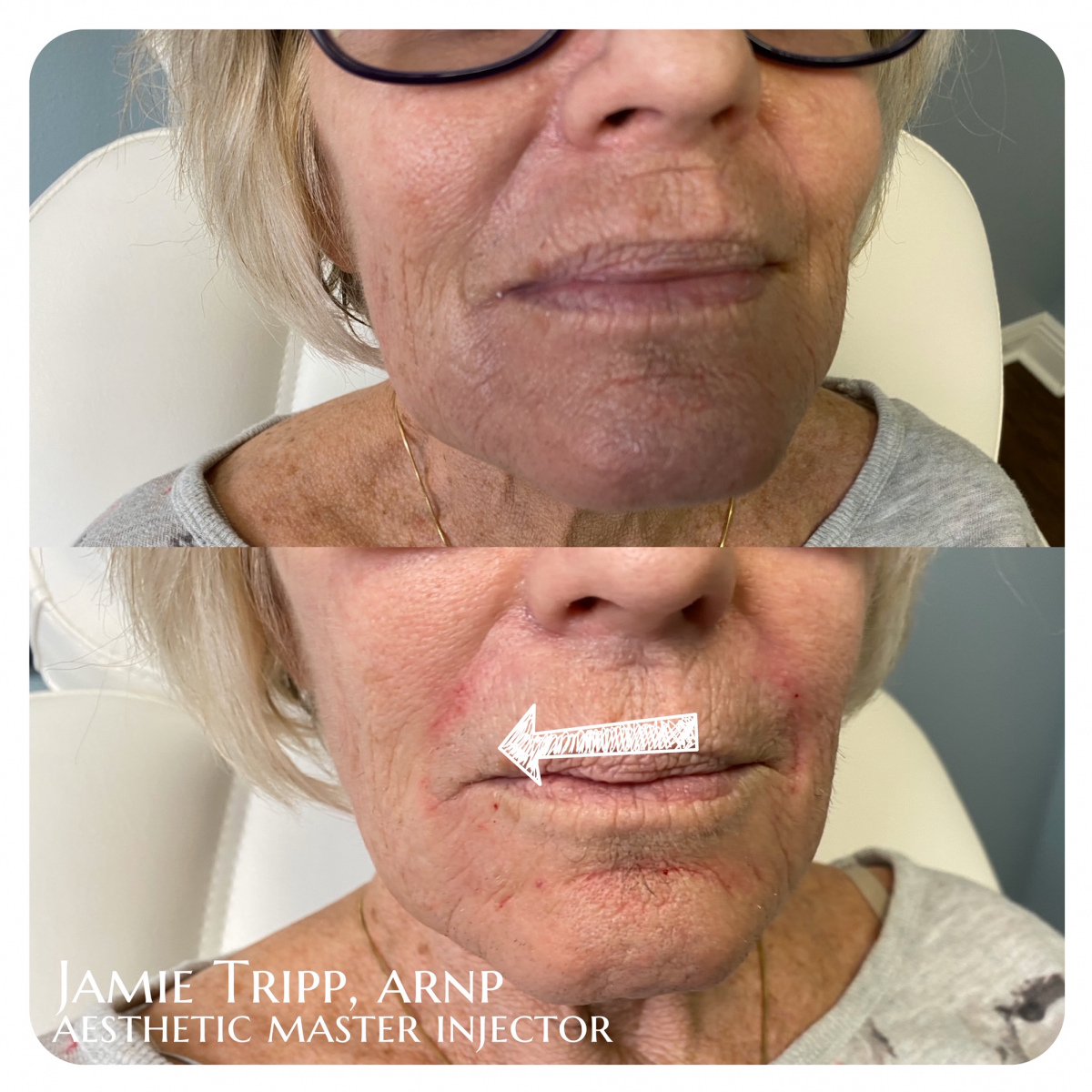 fillers-21