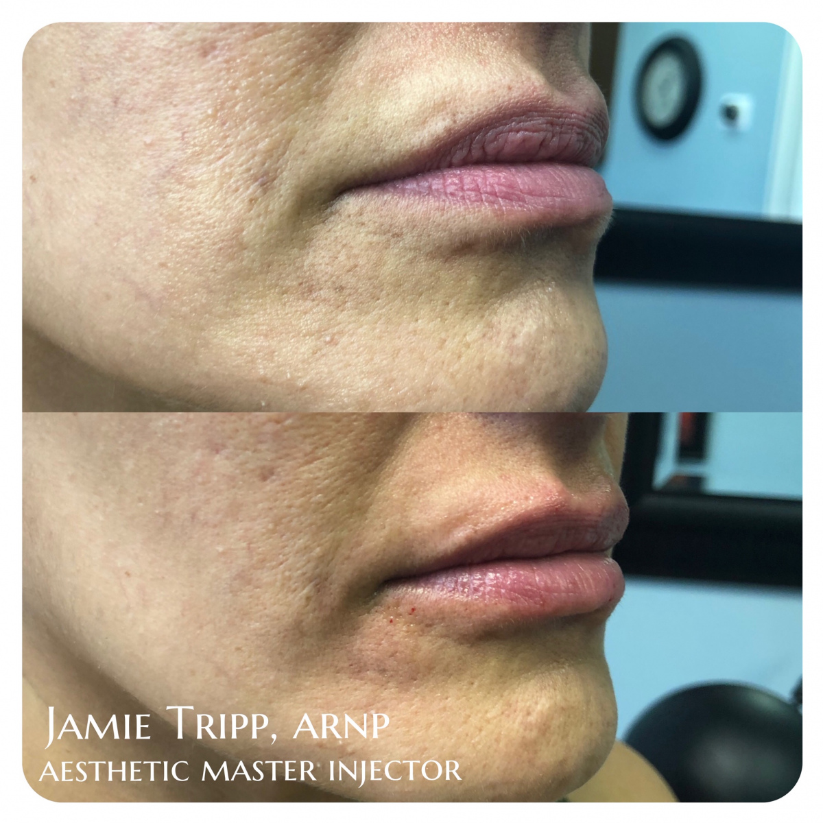 fillers-25