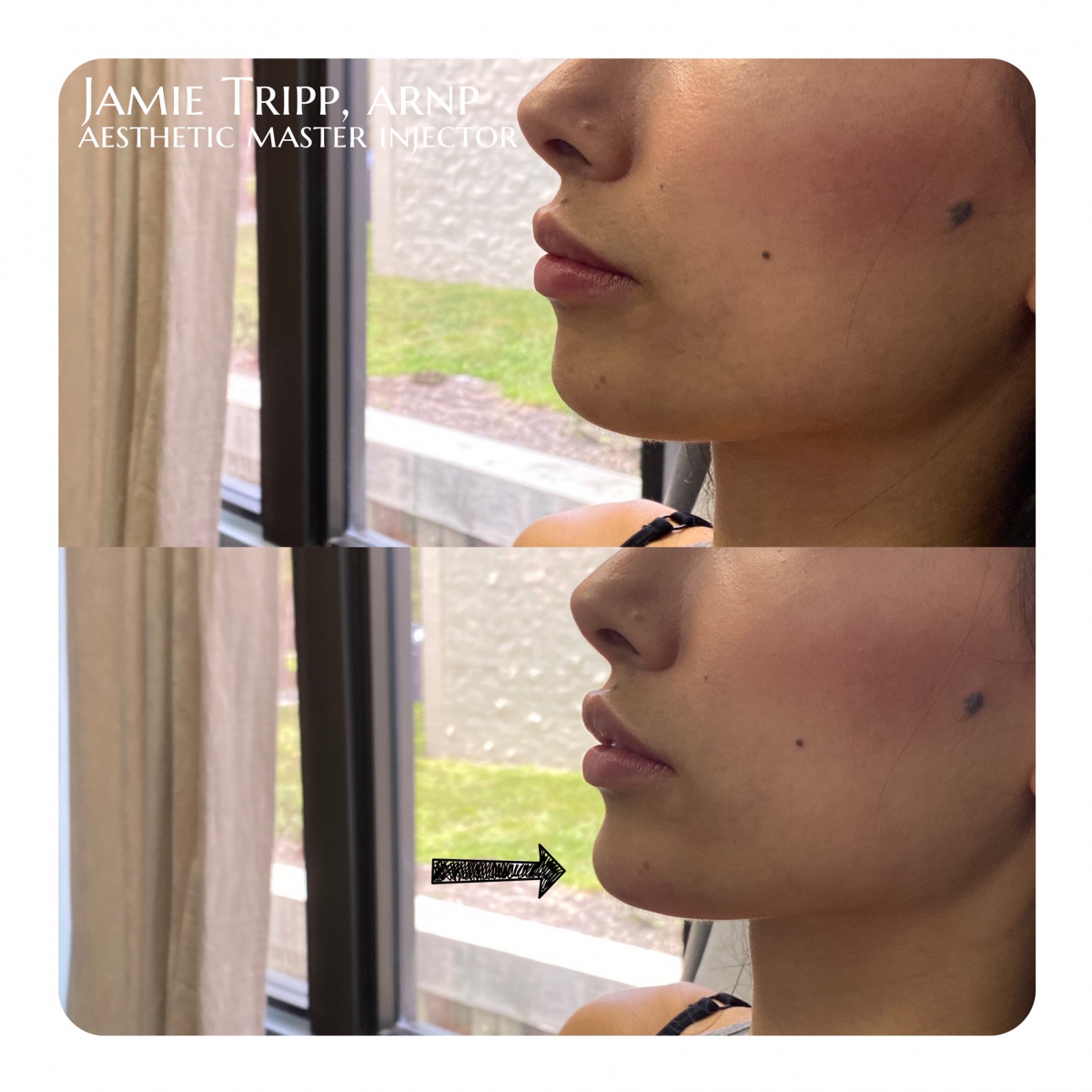 fillers26