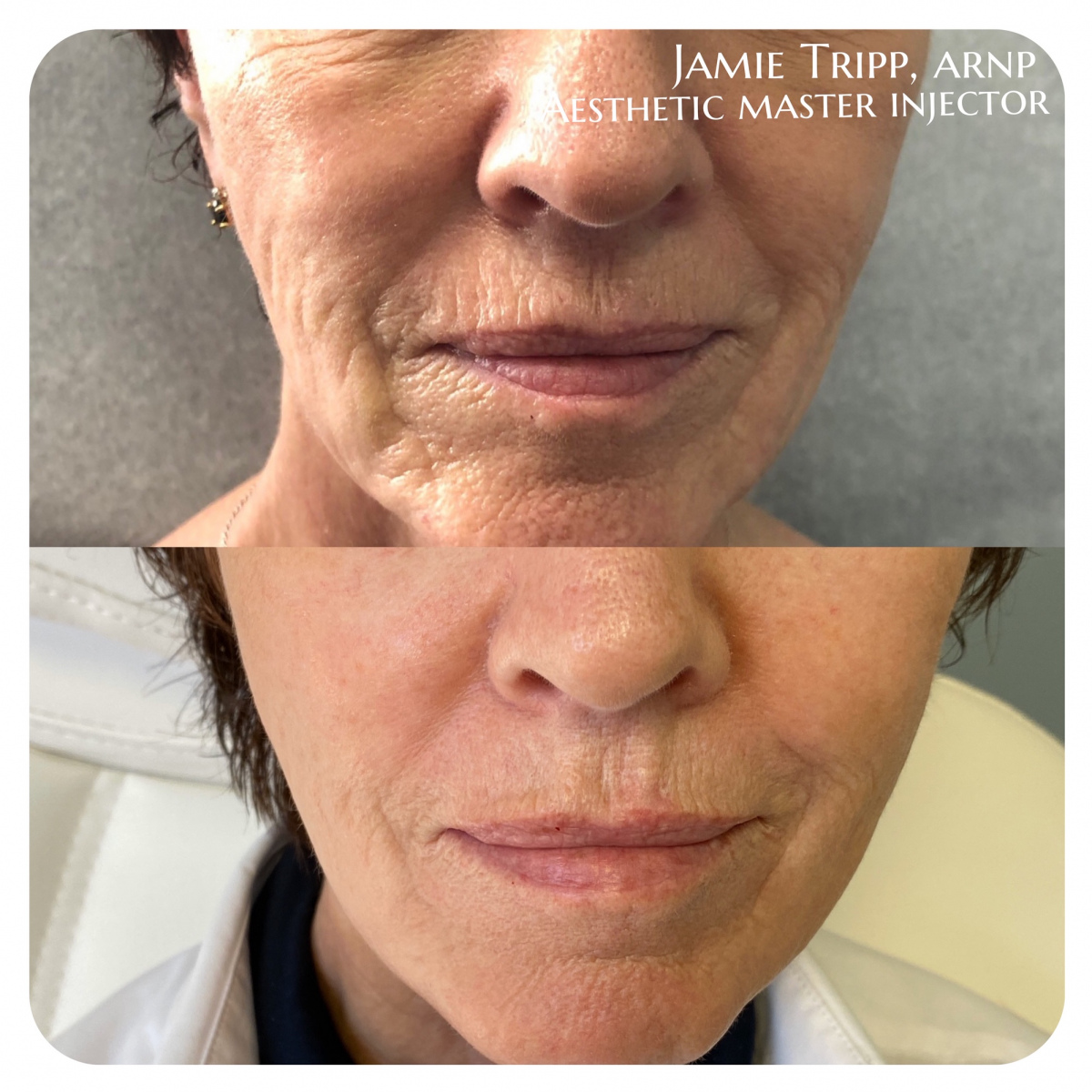 fillers27
