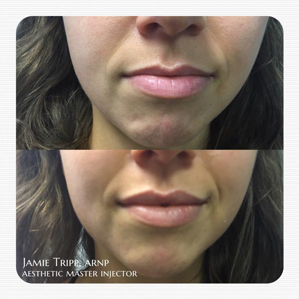 1/2 syringe Juvederm Volbella to lips, immediately after treatment