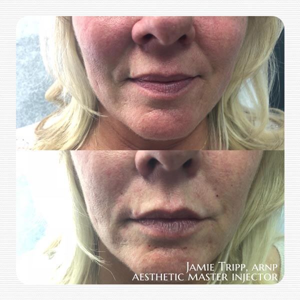 1/2 syringe Juvederm Volbella to lips, immediately after treatment