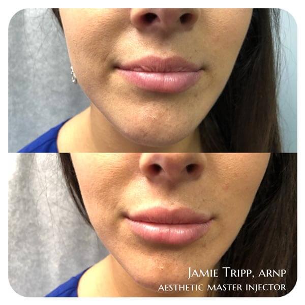 1/2 syringe Juvederm Volbella to lips, immediately after treatment