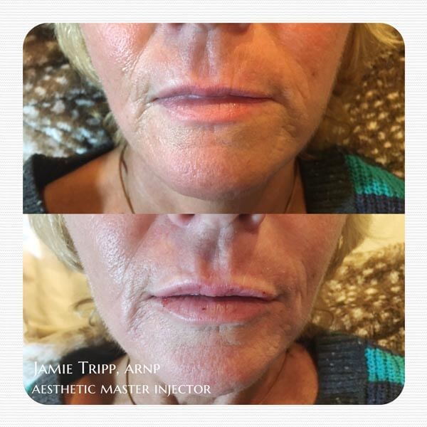 1 syringe Juvederm Vollure to lips, immediately after treatment