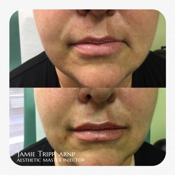 1/2 syringe Juvederm Volbella to lips, immediately after treatment