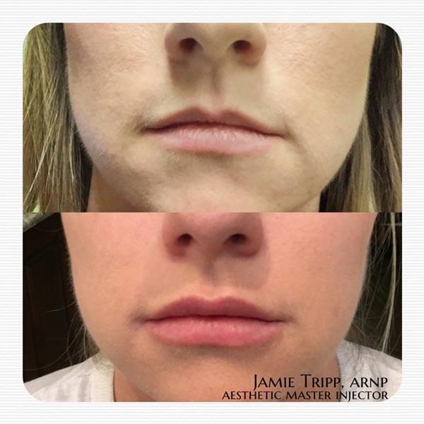 1 syringe Juvederm Vollure to lips, 2 weeks after treatment