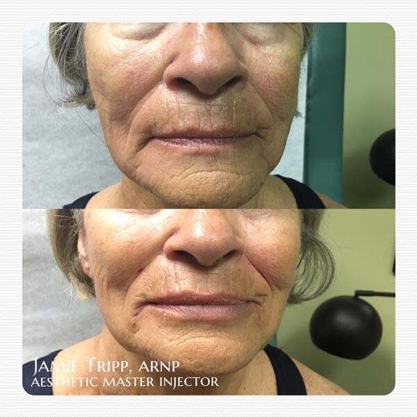 2 syringes Juvederm Vollure to lips, smile lines and corners of mouth, immediately after treatment