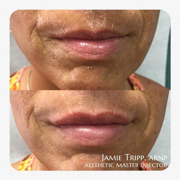 1/2 syringe Juvederm Volbella to lips, immediately after treatment