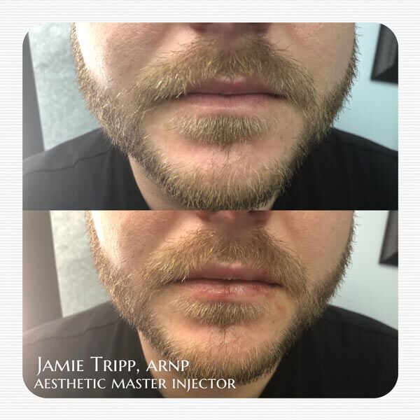 1/2 syringe Juvederm Volbella to lips, immediately after treatment