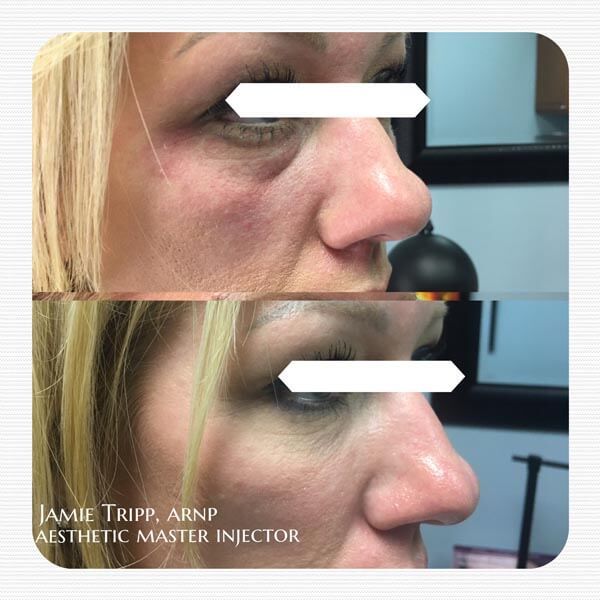 1/2 syringe Juvederm Volbella to under eyes and 1 syringe Juvederm Voluma to cheeks, 2 weeks after treatment