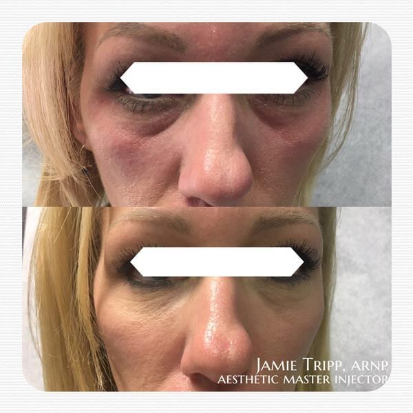 1/2 syringe Juvederm Volbella to under eyes and 1 syringe Juvederm Voluma to cheeks, 2 weeks after treatment