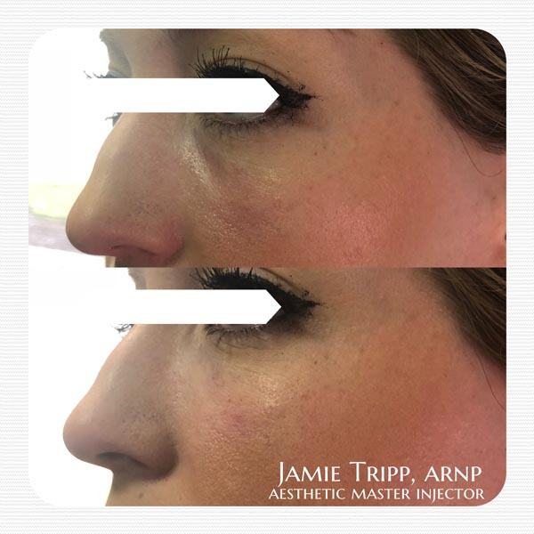 1/2 syringe Juvederm Volbella to under eyes, immediately after treatment