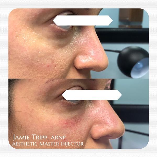 1/2 syringe Juvederm Volbella to under eyes, immediately after treatment