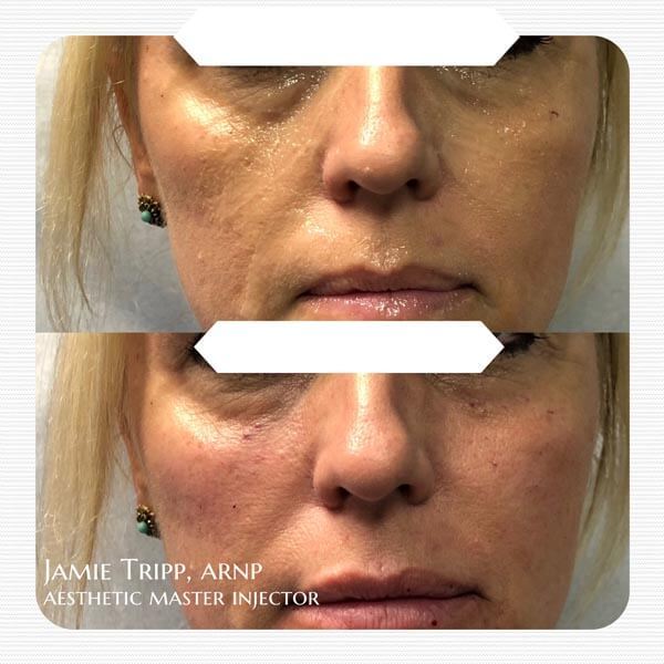 1/2 syringe Juvederm Volbella to under eyes and 1 syringe Juvederm Voluma to cheeks, immediately after treatment