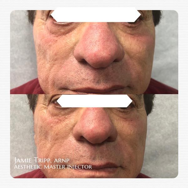 1/2 syringe Juvederm Volbella to under eyes, immediately after treatment