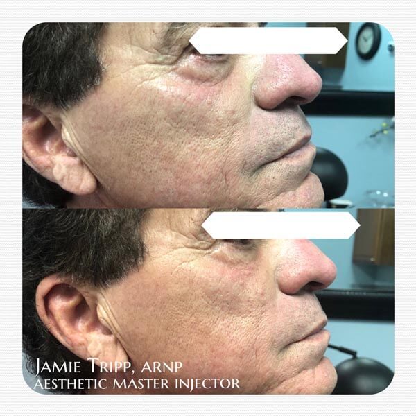 1/2 syringe Juvederm Volbella to under eyes, immediately after treatment