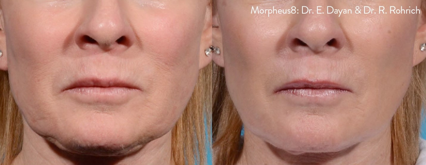 beforeandAfter1