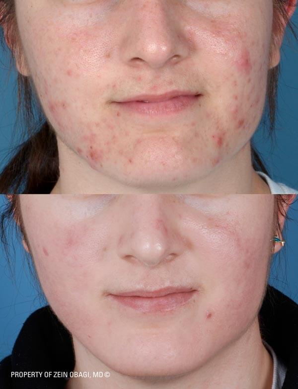 ZO Skincare Before and After 4