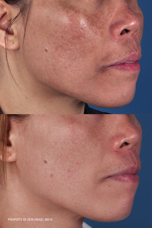 ZO Skincare Before and After 20